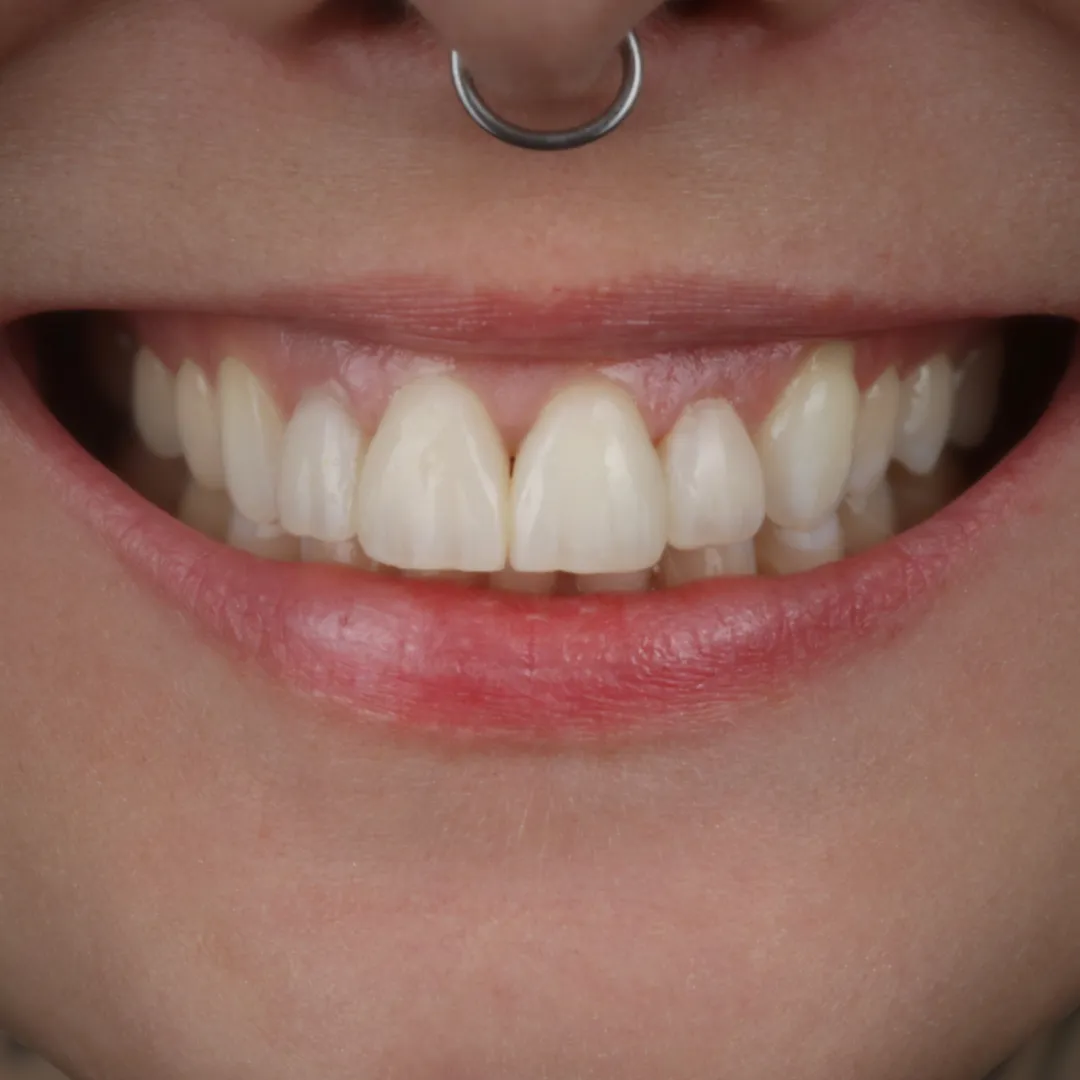 Efekt finalny odbudowy – autor: lek. dent. Michał Sroka