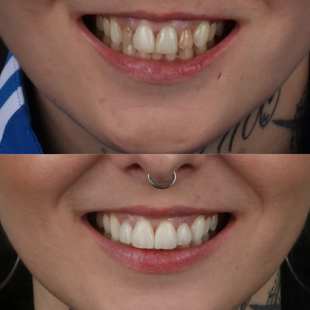 Porównanie przed i po – autor: lek. dent. Michał Sroka