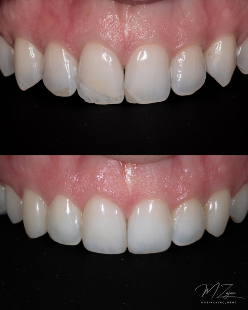 Widok górnego łuku zębowego przed i po odbudowie estetycznej – dokumentacja przypadku, lek. dent. Małgorzata Zając
