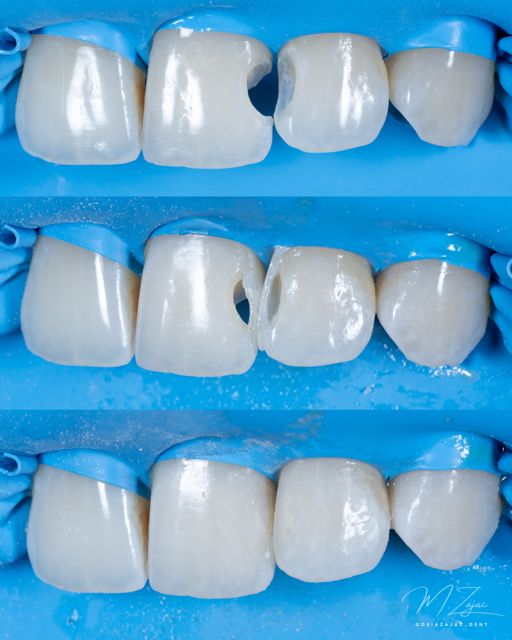 Przypadek w koferdamie – izolacja pola zabiegowego podczas odbudowy estetycznej, dokumentacja kliniczna, lek. dent. Małgorzata Zając