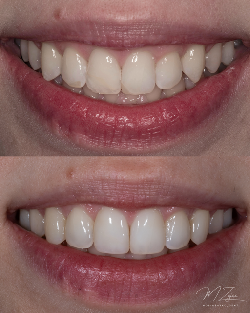 Porównanie uśmiechu przed i po odbudowie estetycznej w odcinku przednim – przypadek kliniczny, lek. dent. Małgorzata Zając